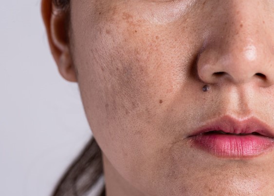 عوامل ایجاد لک بر روی پوست صورت و بدن